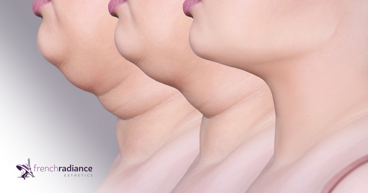 Use KYBELLA® to Slim Down in 2021