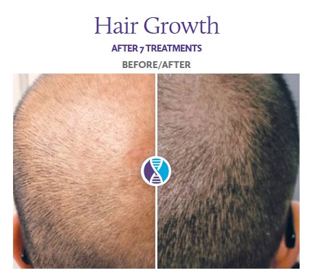 Stem Cell Hair Regrowth Before and After