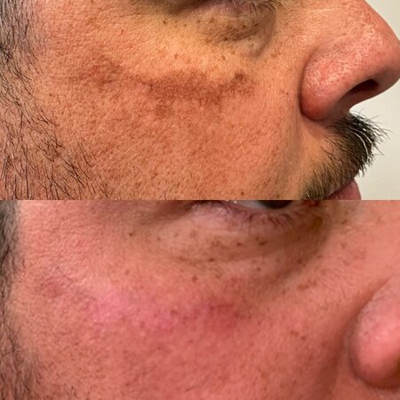 ADVATx Laser Melasma Treatment Before and After
