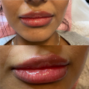 French Radiance Esthetics JUVÉDERM® Volbella™ Lip Fillers