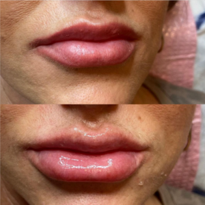 French Radiance Esthetics JUVÉDERM® Volbella™ Lip Fillers
