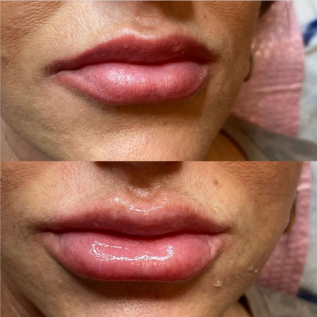 Juv Derm Volbella Creates Plump Kissable Lips