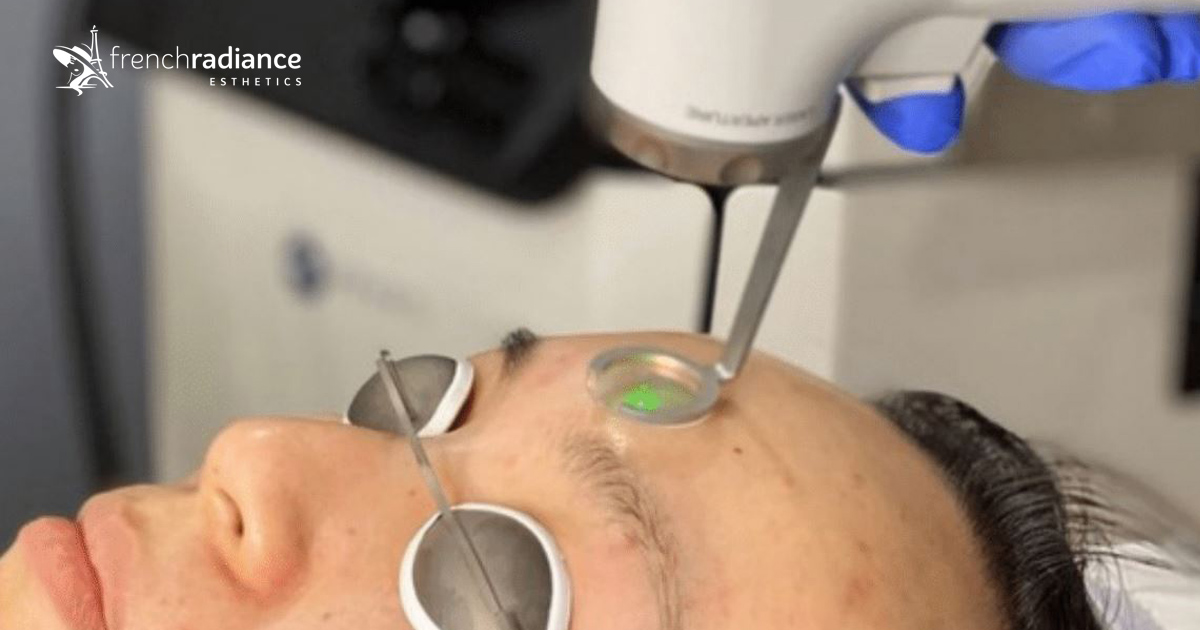 Infrared Laser Treatment for Acne Scars