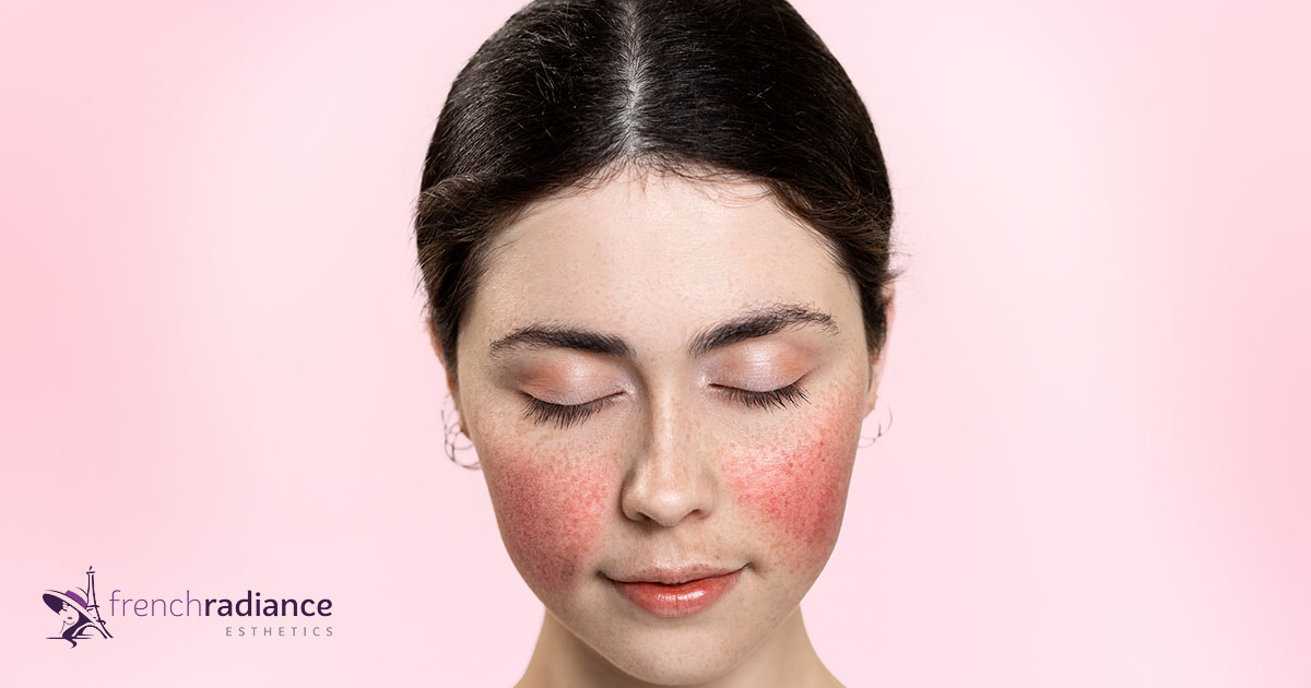 rosacea cheeks treatment